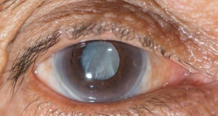 Novo Colírio Pode Dissolver Catarata Sem Necessidade De Cirurgia